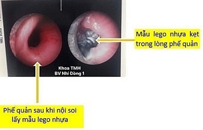 Hình ảnh dị vật mắc kẹt trong phế quản và sau khi được gắp ra ngoài. Ảnh: Bệnh viện Nhi đồng 1
