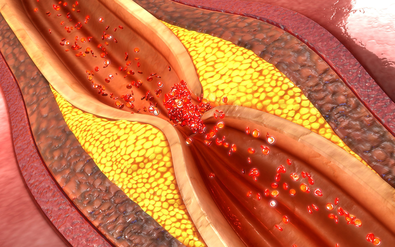 Coronary artery disease is one of the risk factors for ventricular tachycardia. Photo: Shutterstock