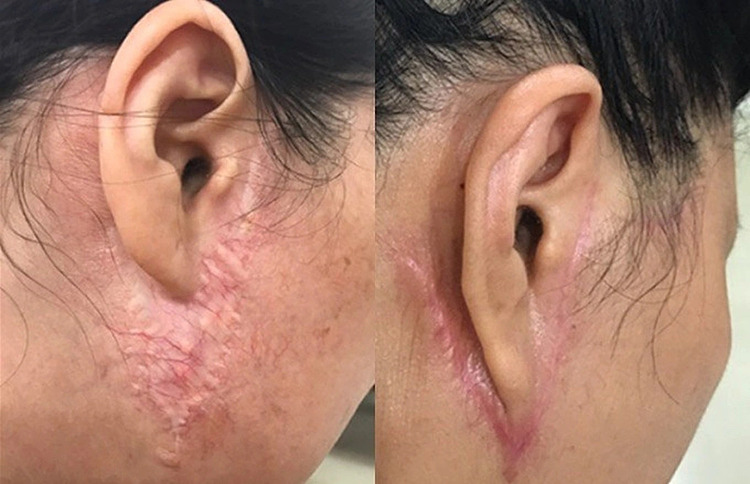 Một ca biến chứng khi căng da mặt phẫu thuật sai kỹ thuật. Ảnh: Bác sĩ cung cấp